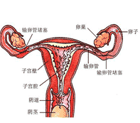輸卵管不孕