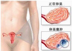 <b>卵巢囊腫必須手術(shù)嗎？</b>